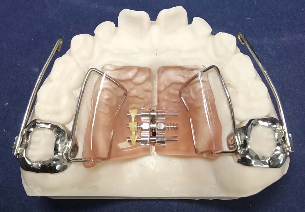 A model of a person's teeth with braces on it