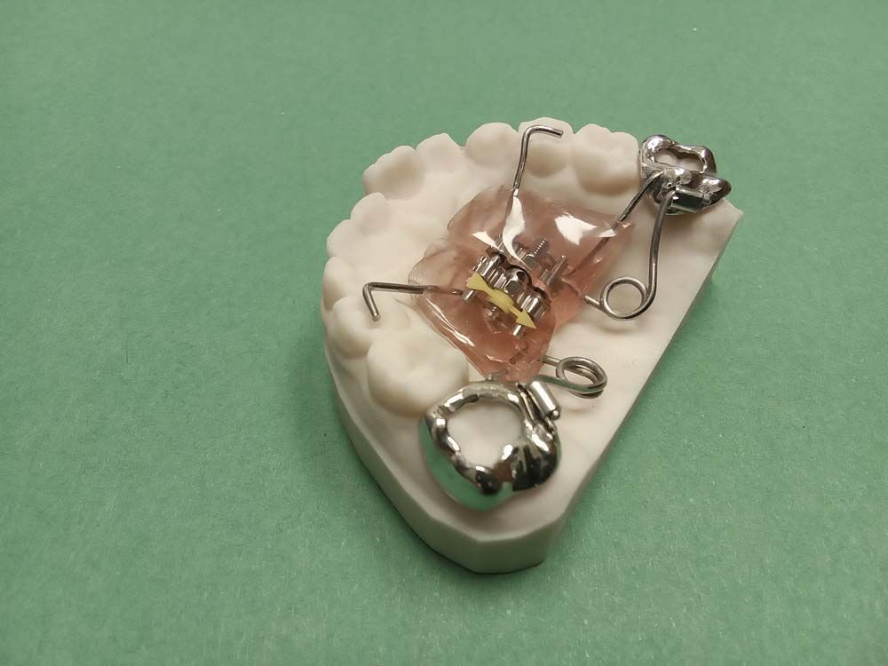 A model of a tooth with a dental device on it