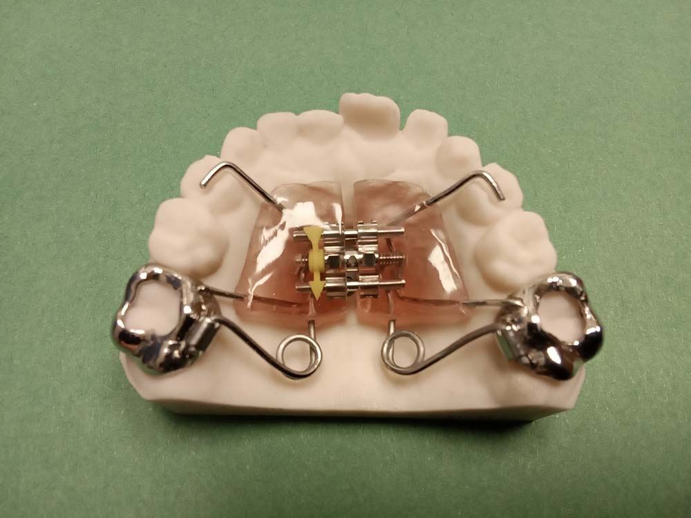 A model of a tooth with braces on it