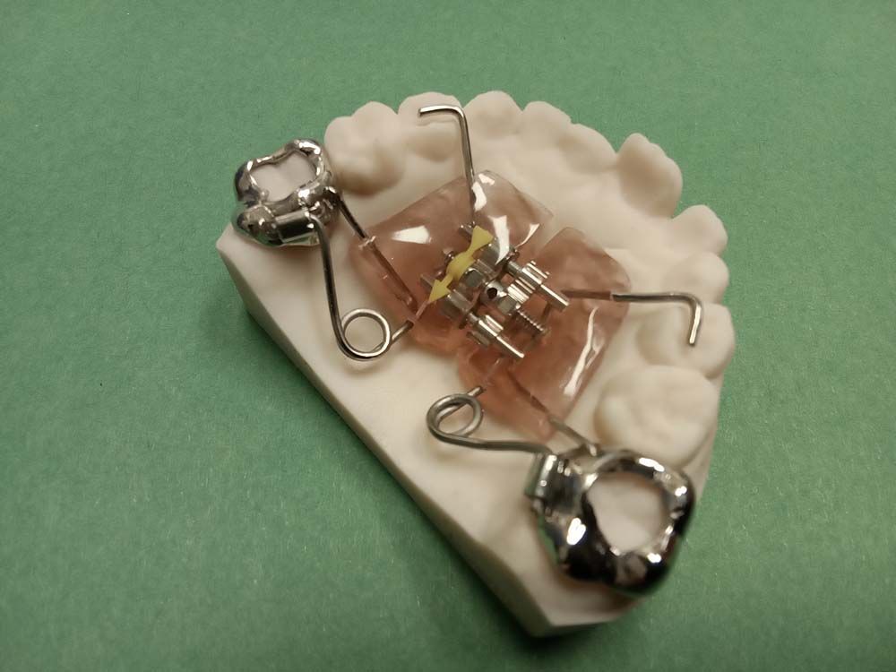 A model of a tooth with a brace on it