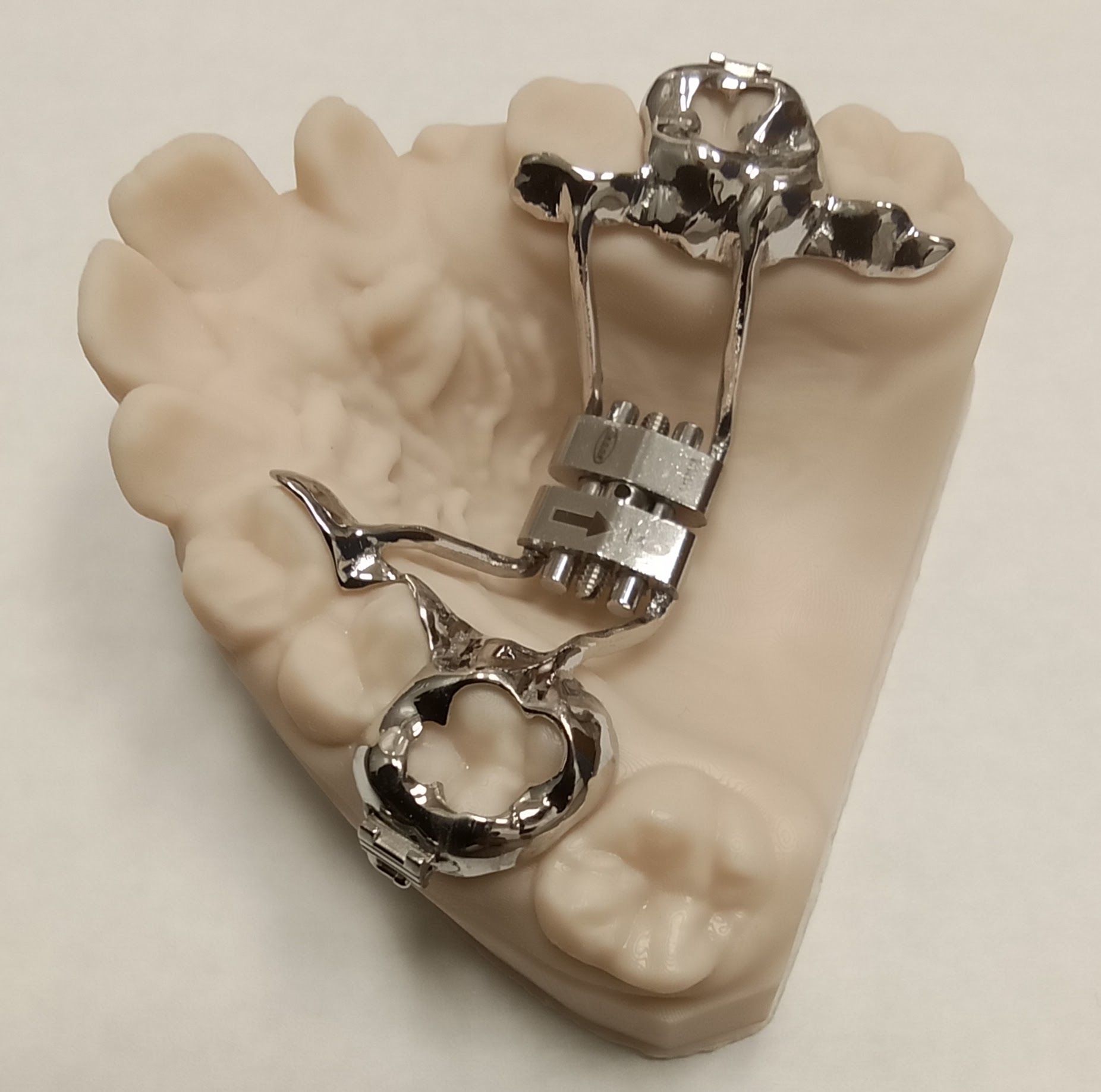 A dental model with a Hyrax expander attached