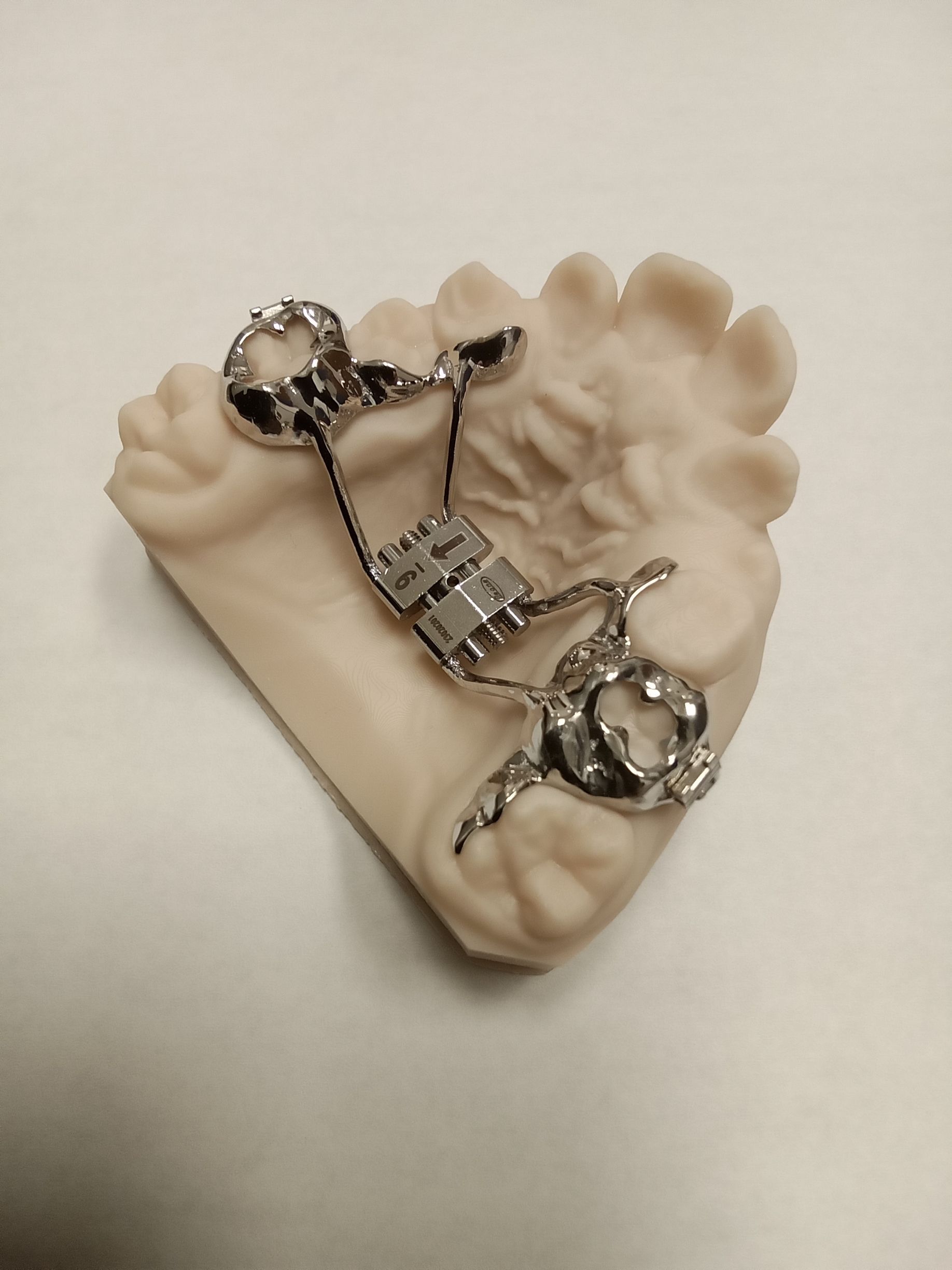 A dental model with a Hyrax expander attached