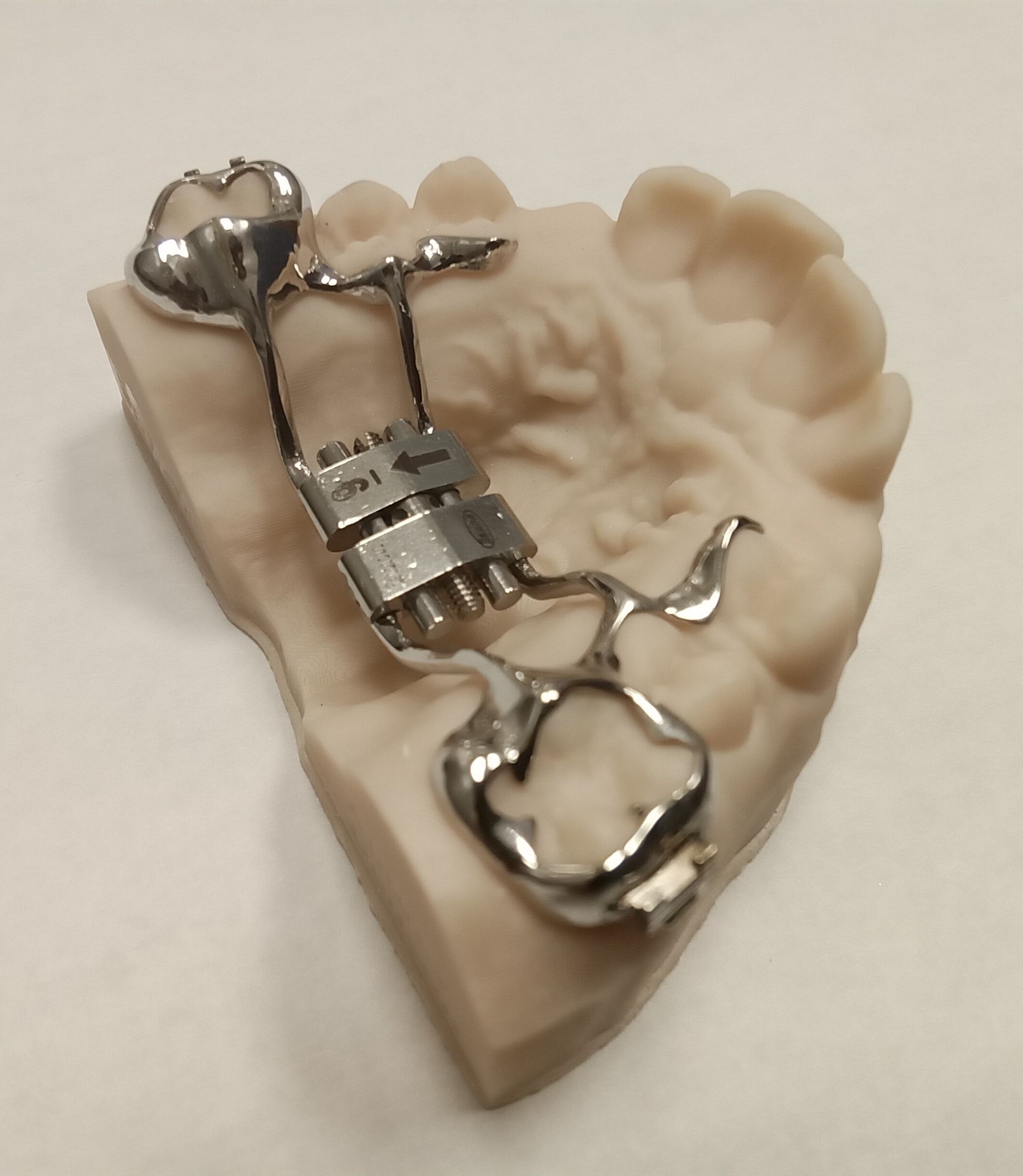 A dental model with a Hyrax expander attached