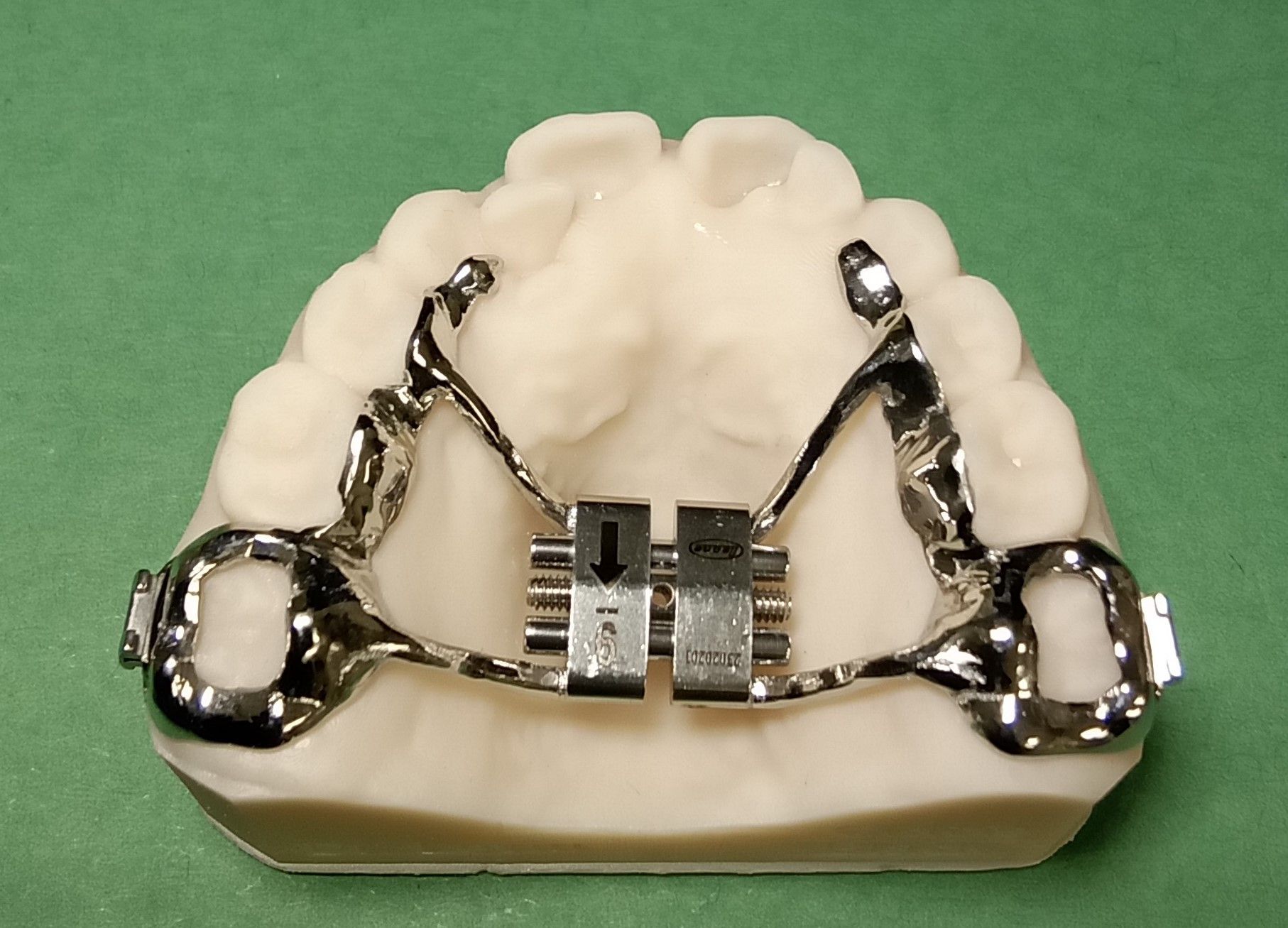 A dental model with a Hyrax expander attached