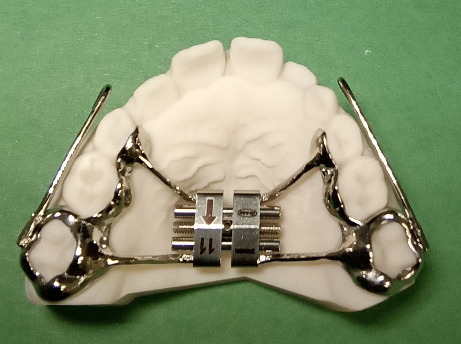 A dental model with a Hyrax expander attached