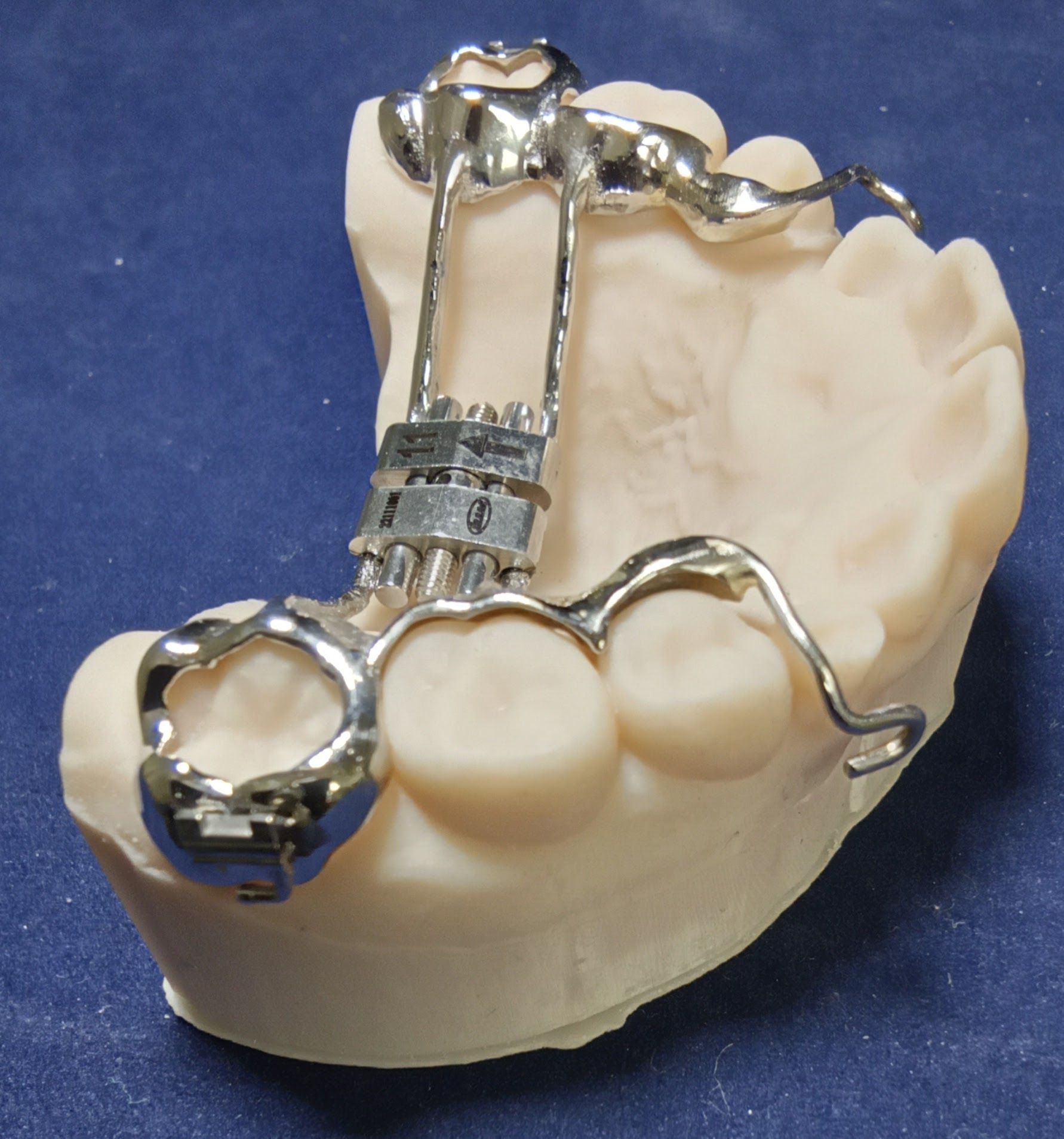 A dental cast featuring a Hyrax expander appliance, with metallic sintered bands