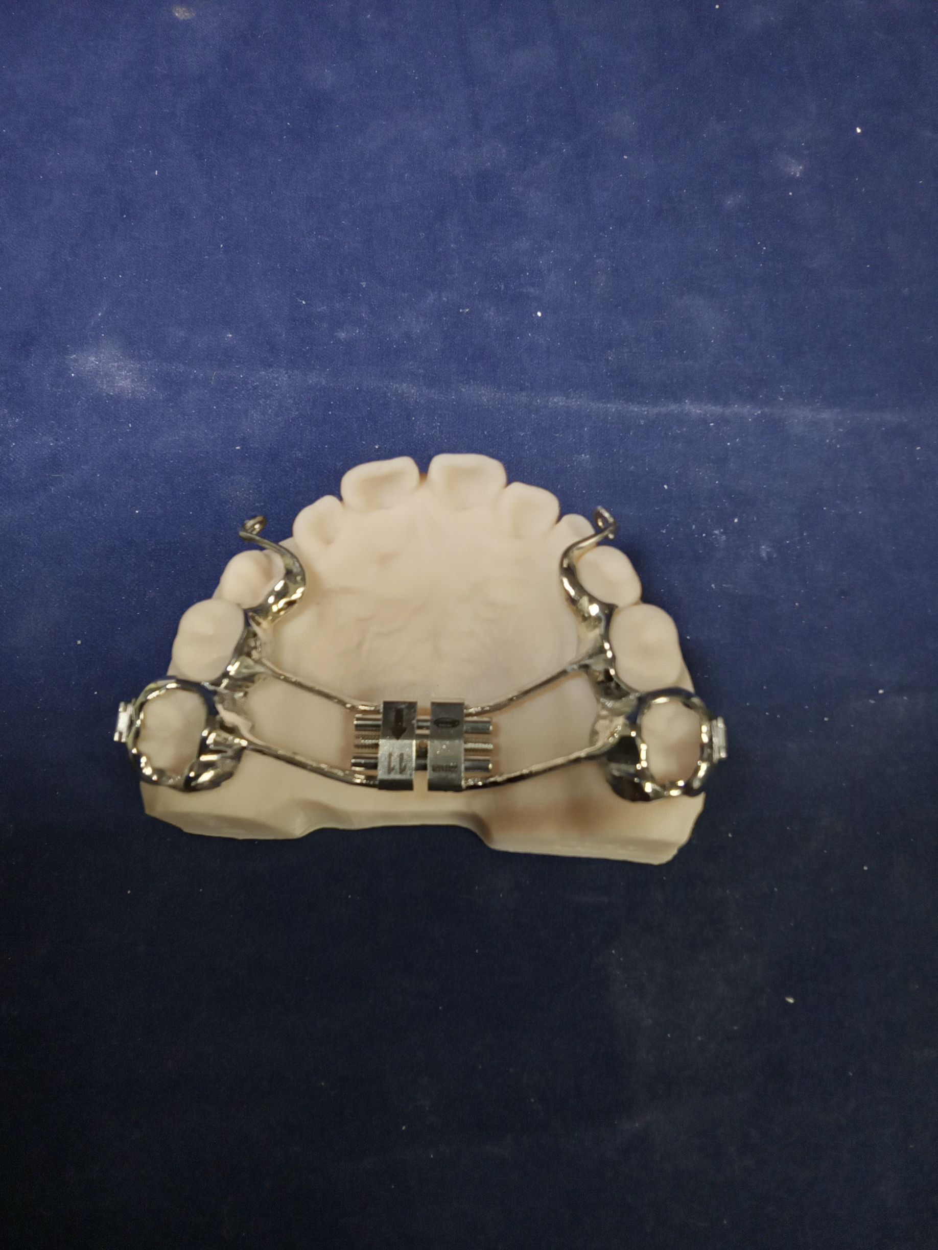 A dental cast featuring a Hyrax expander appliance, with metallic sintered bands
