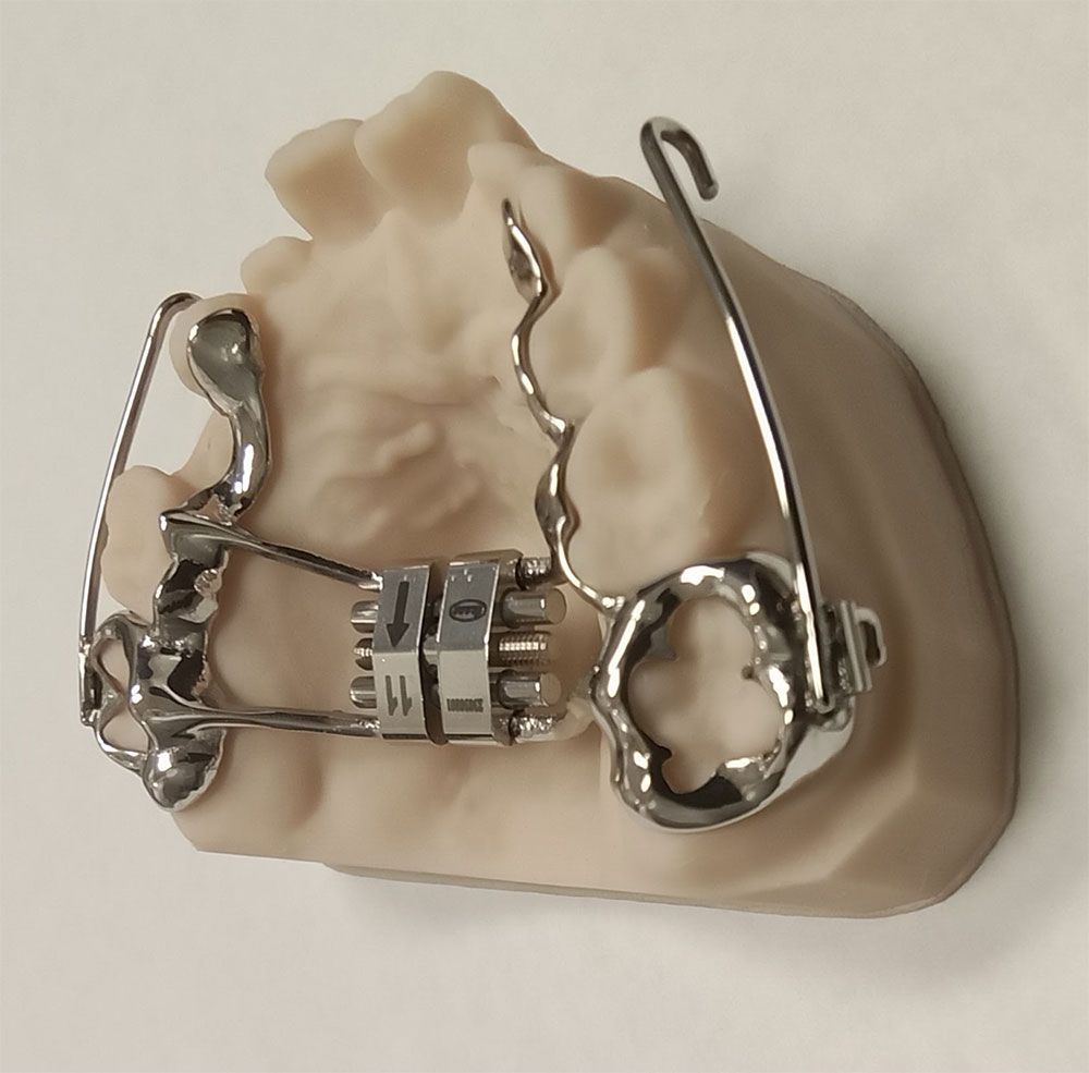 A dental cast displays a Hyrax expander with sintered bands and metal arms featuring FM hooks