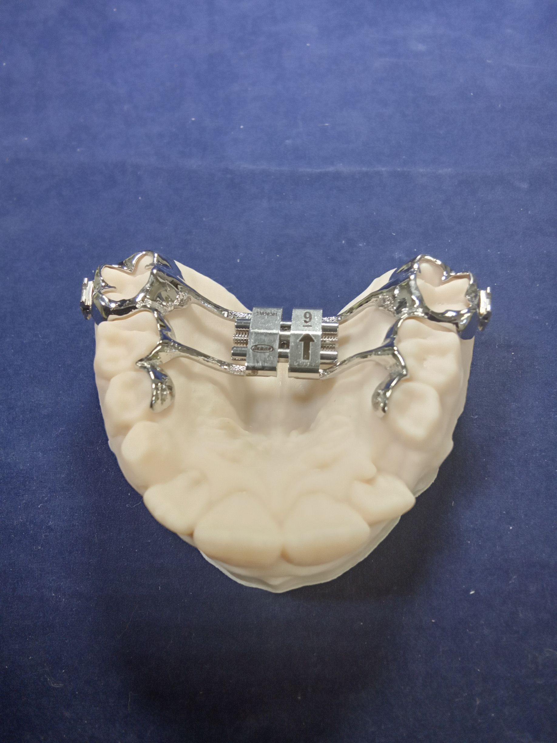 A dental cast shows a Hyrax expander with sintered bands and metal arms extending to the C's