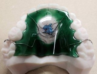 A close up of a dental retainer with a dolphin on it.