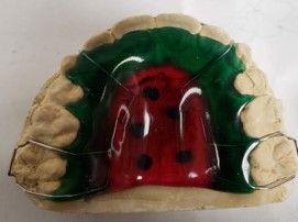A model of a person's teeth with a red and green brace.