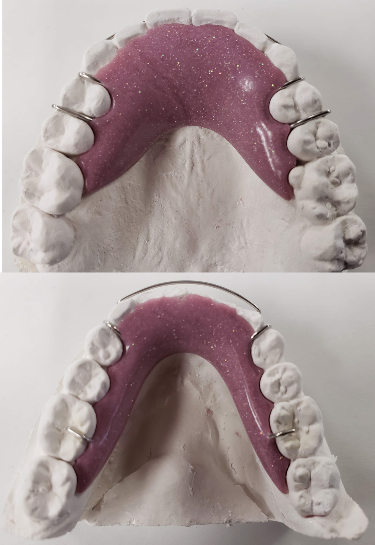 A model of a person's teeth with a purple brace