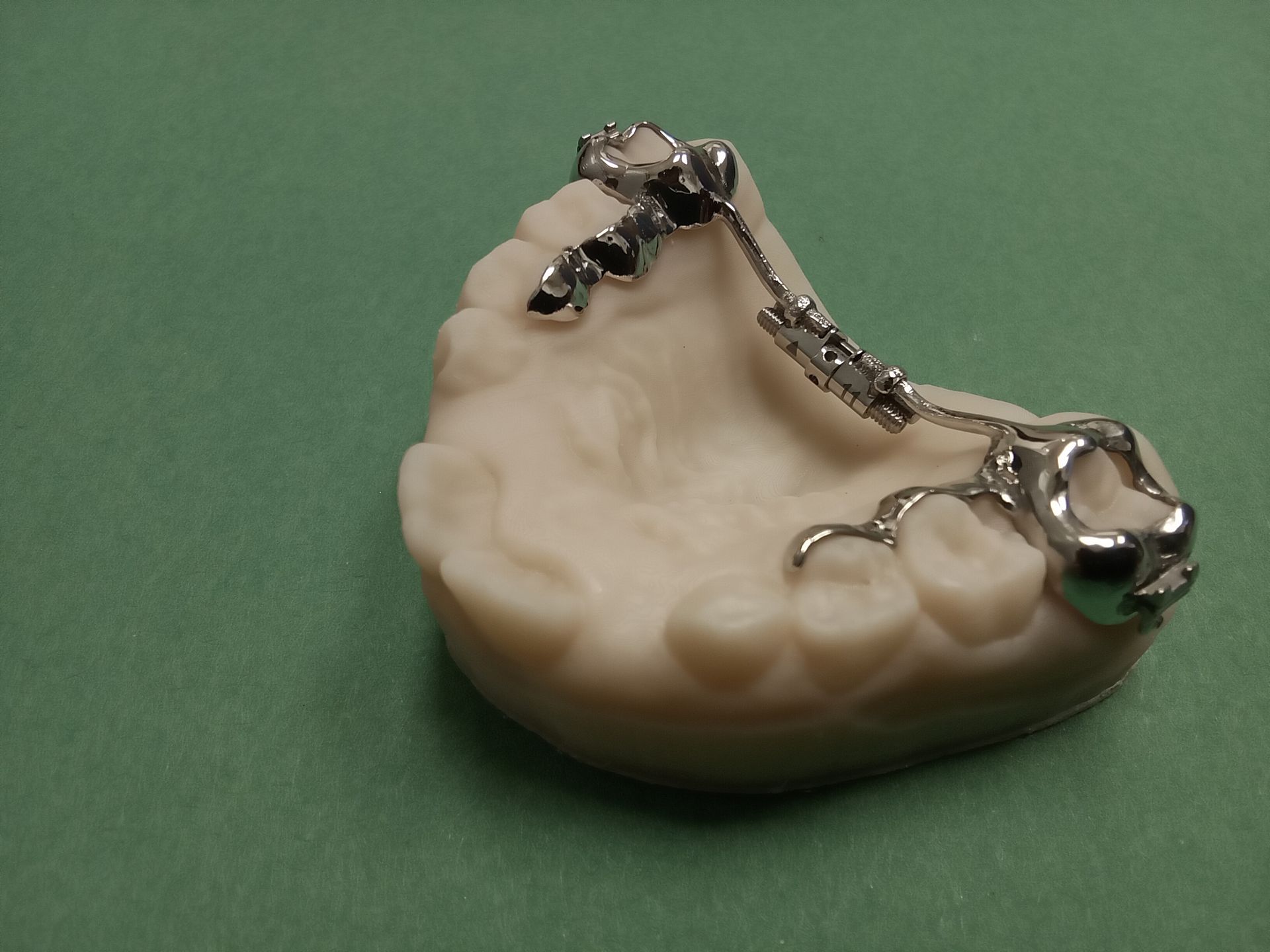 A model of a tooth with a metal bracket attached to it