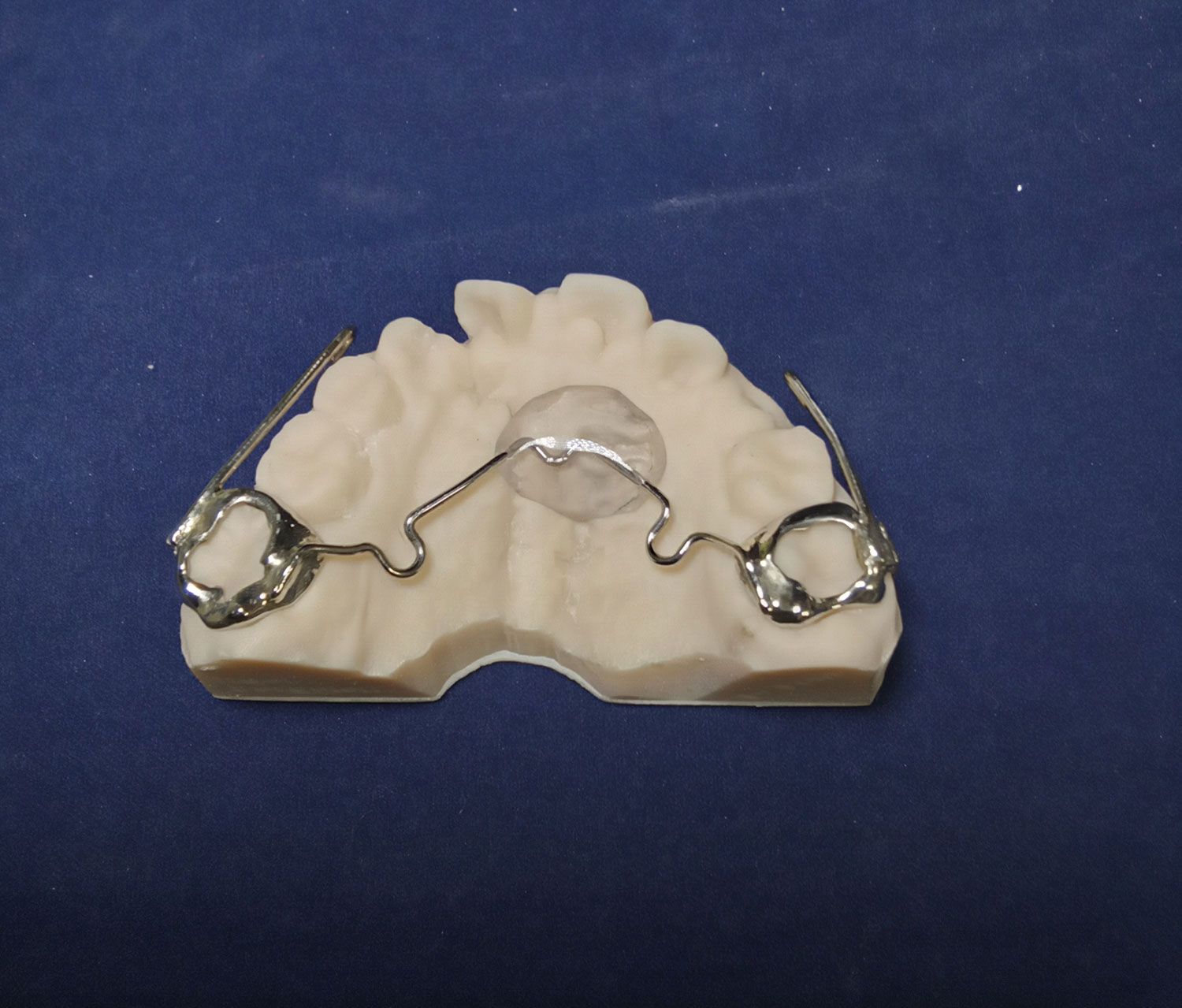 A Nance appliance used to maintain space in the upper arch