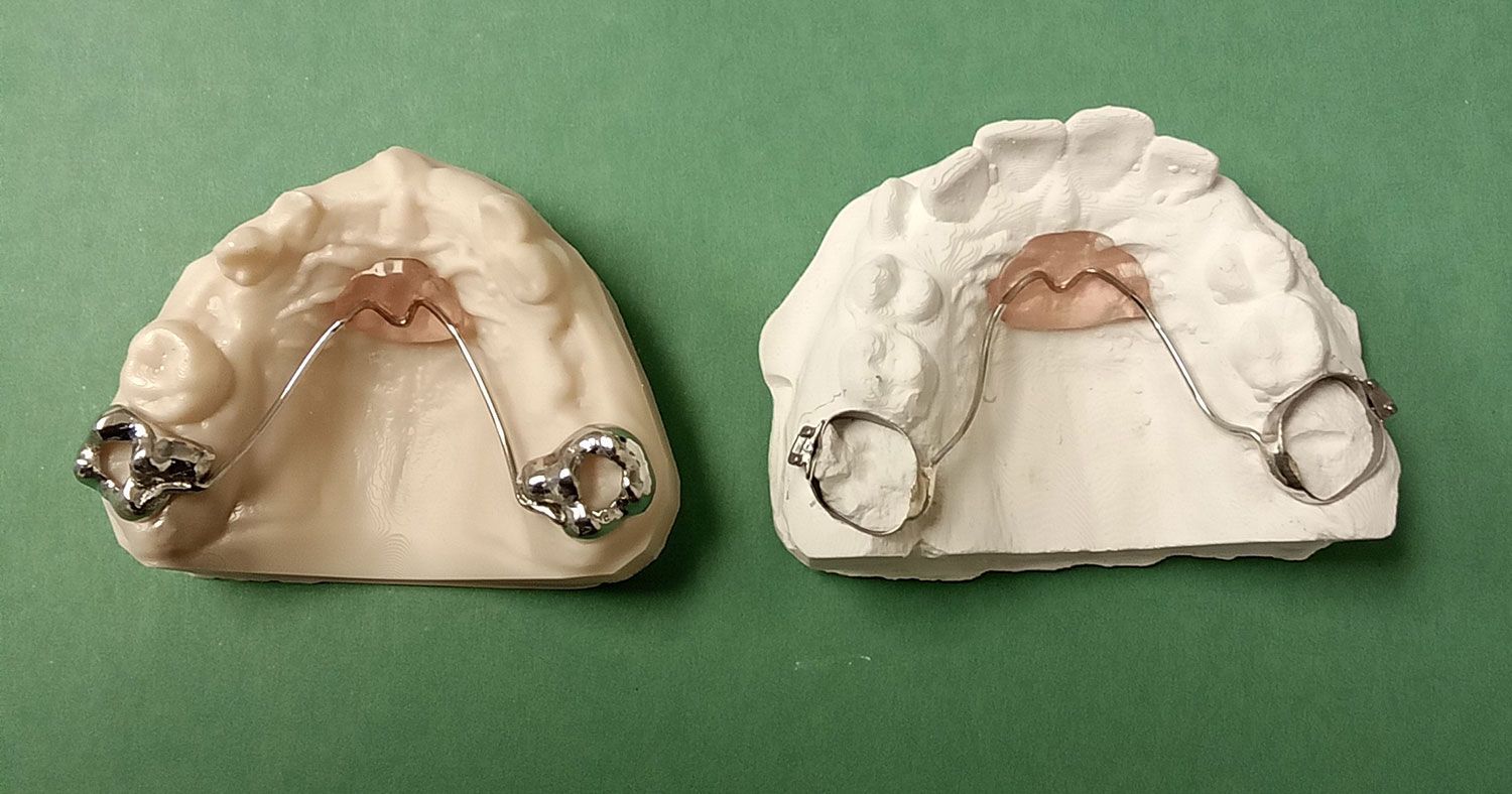 A Nance dental appliance, consisting of a curved metal wire with side loops embedded in two molded bases