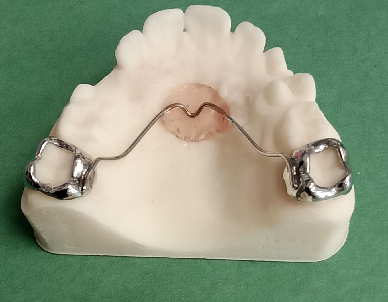 A Nance appliance used to maintain space in the upper arch