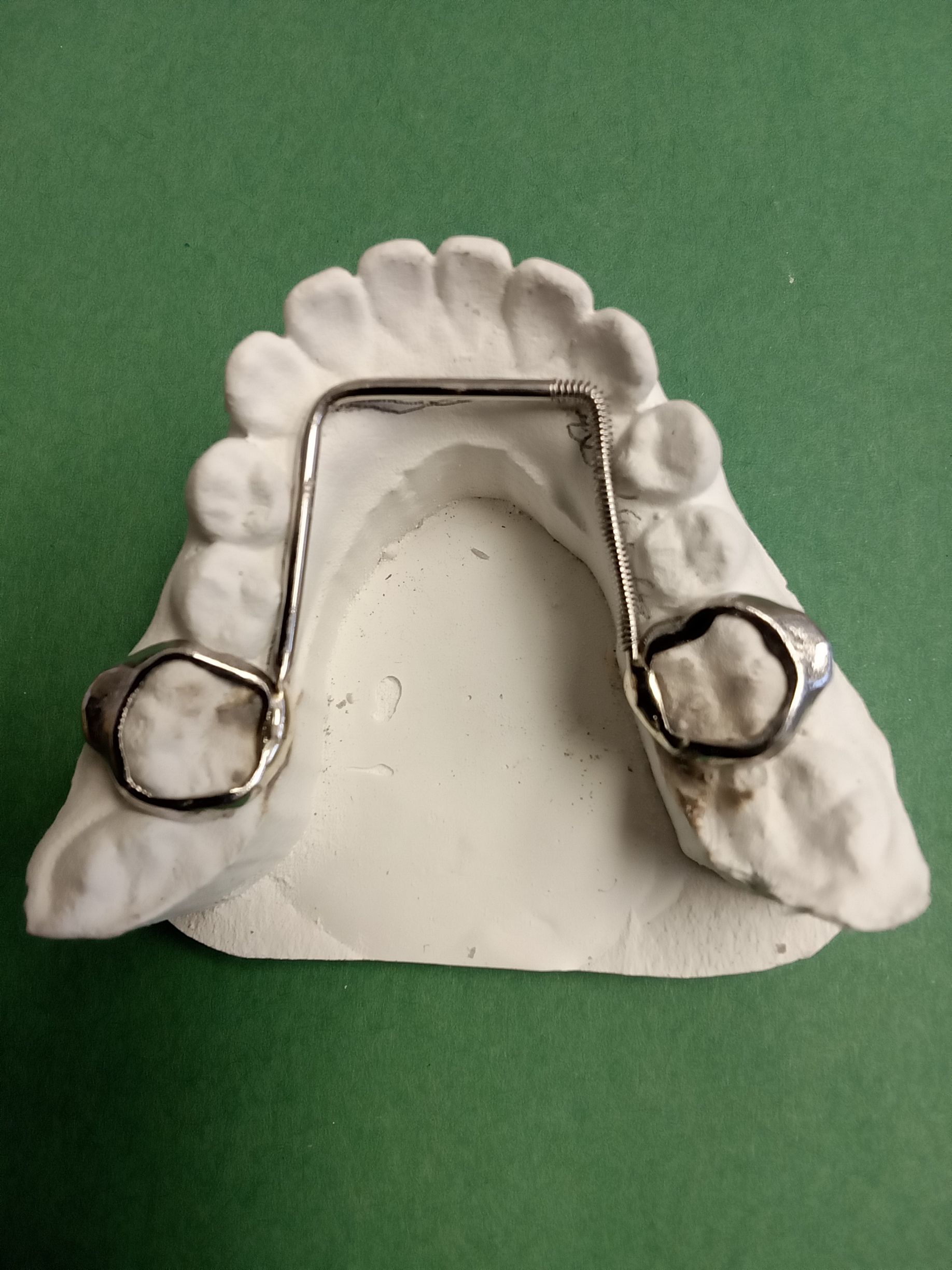 A model of a tooth with a metal brace on it