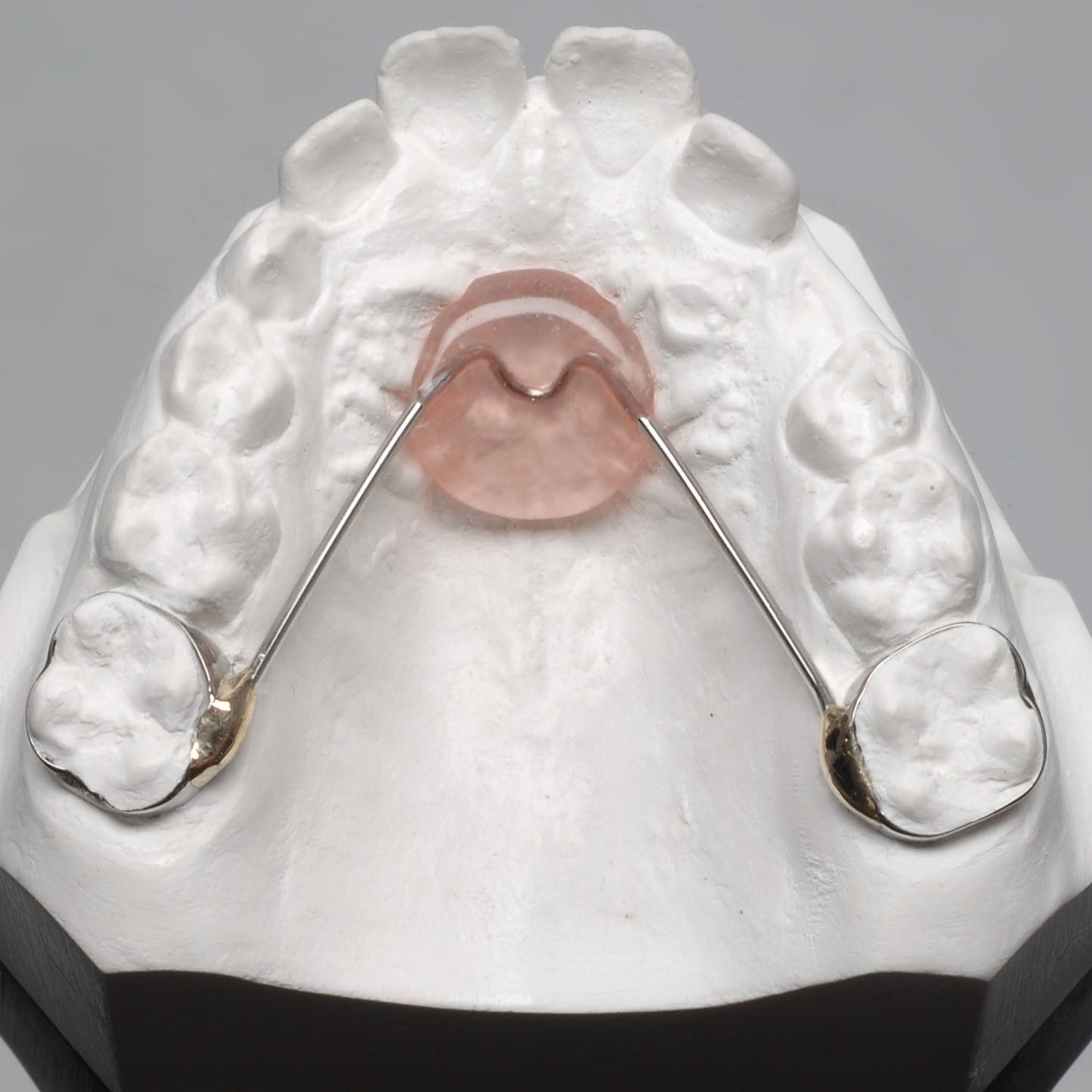 A Nance appliance used to maintain space in the upper arch