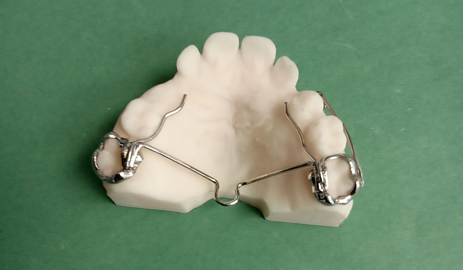 A model of a tooth with a metal brace on it