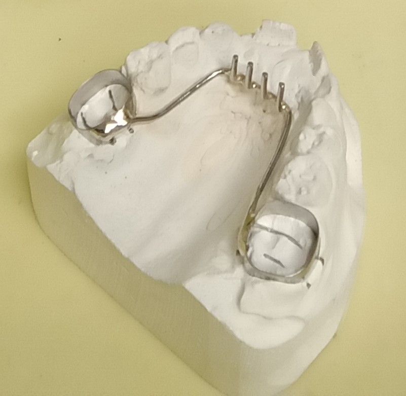 A model of a person's teeth with braces on it.