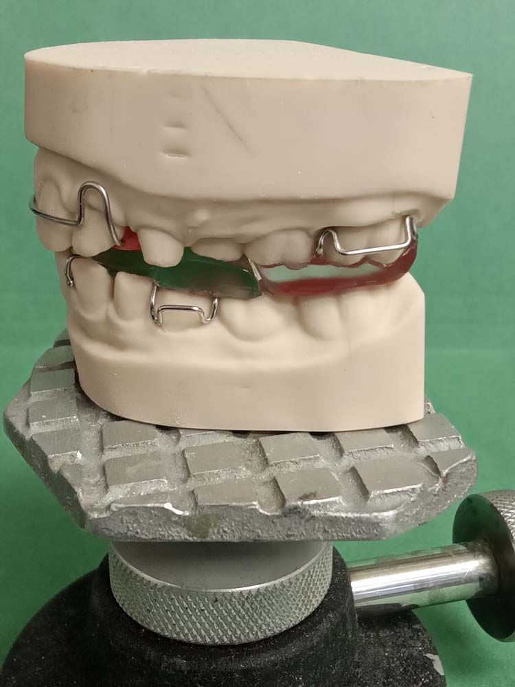 A model of a mouth with braces on it