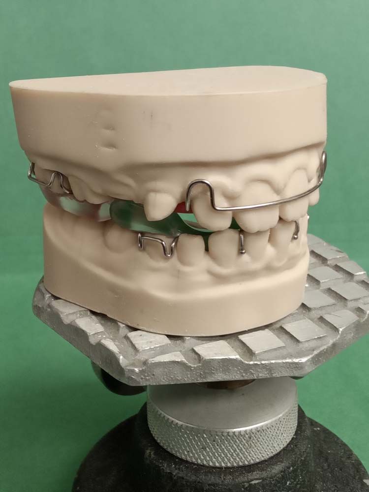 A model of a person's teeth with braces on them