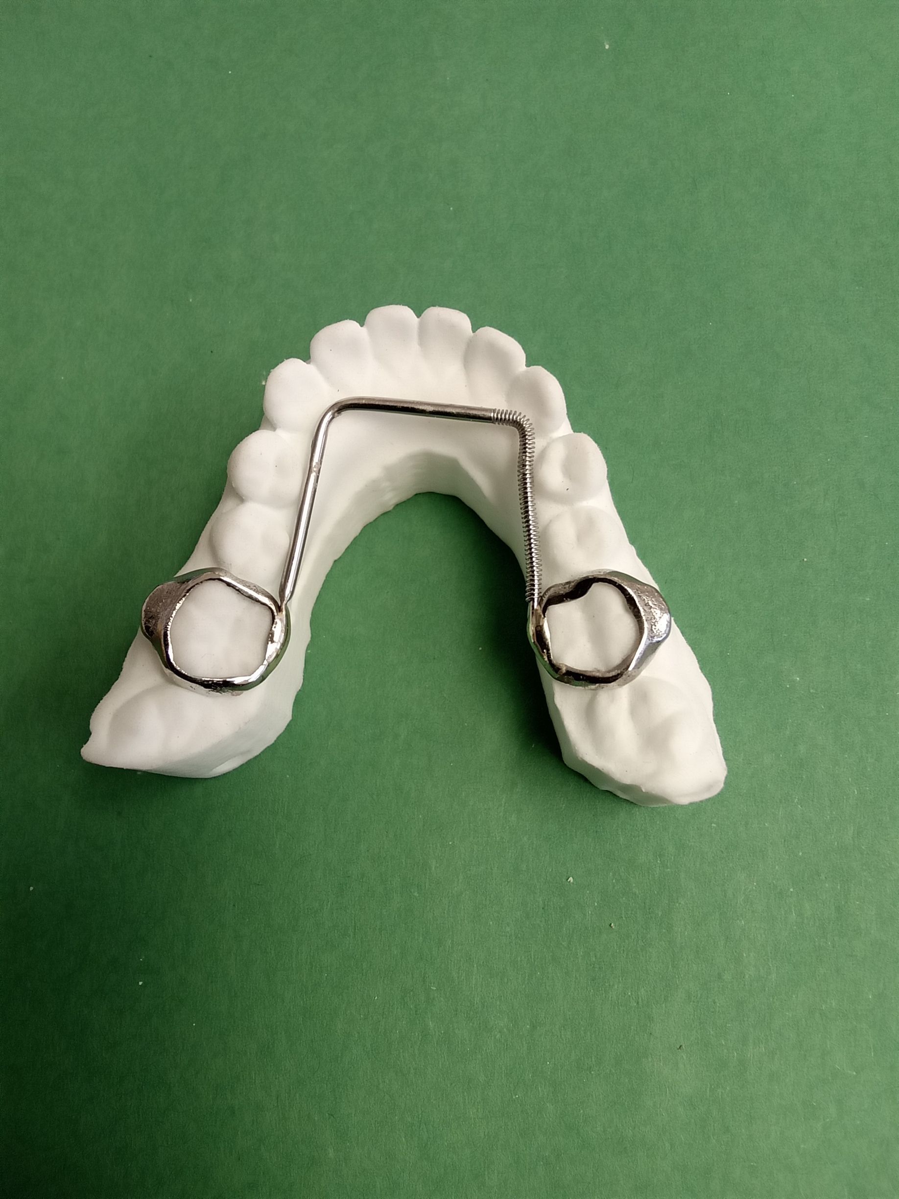 A model of a tooth with a metal brace