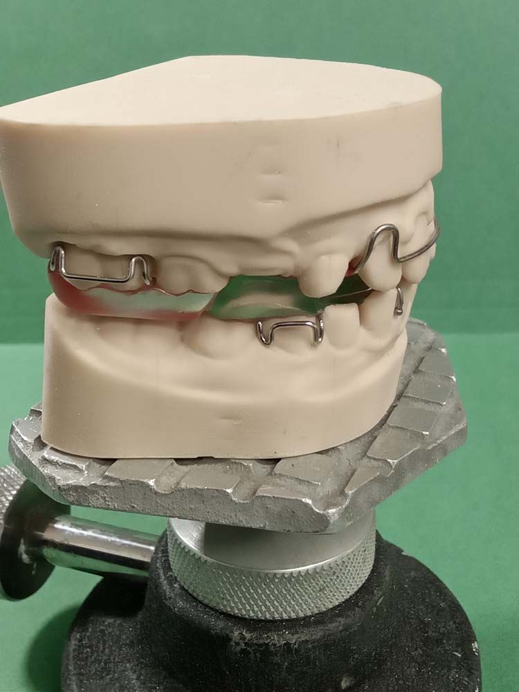 A model of a person's teeth with braces on it