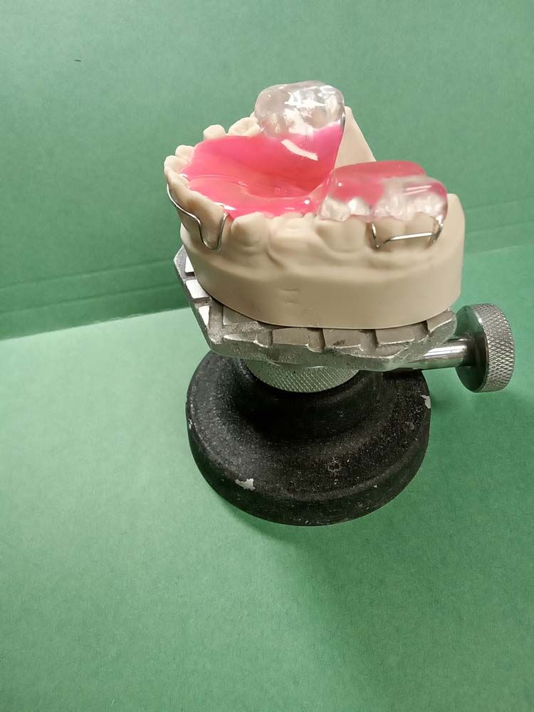 A model of a tooth with a pink tooth missing