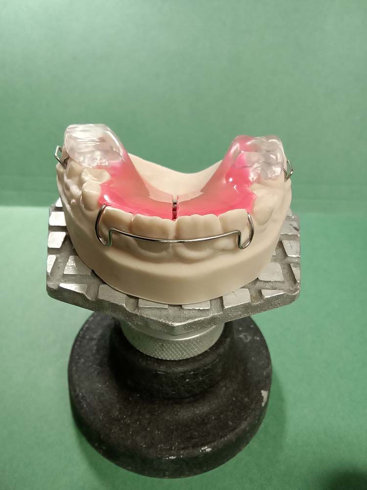 A model of a person's teeth with braces on it.
