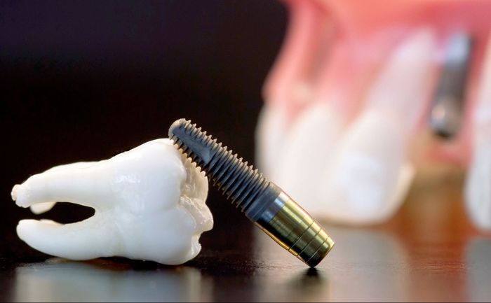 A tooth and a dental implant are on a table.