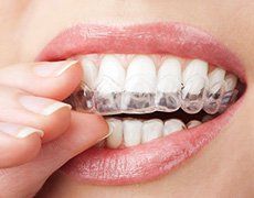 Teeth with Invisalign