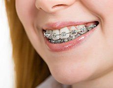 Woman with braces on teeth