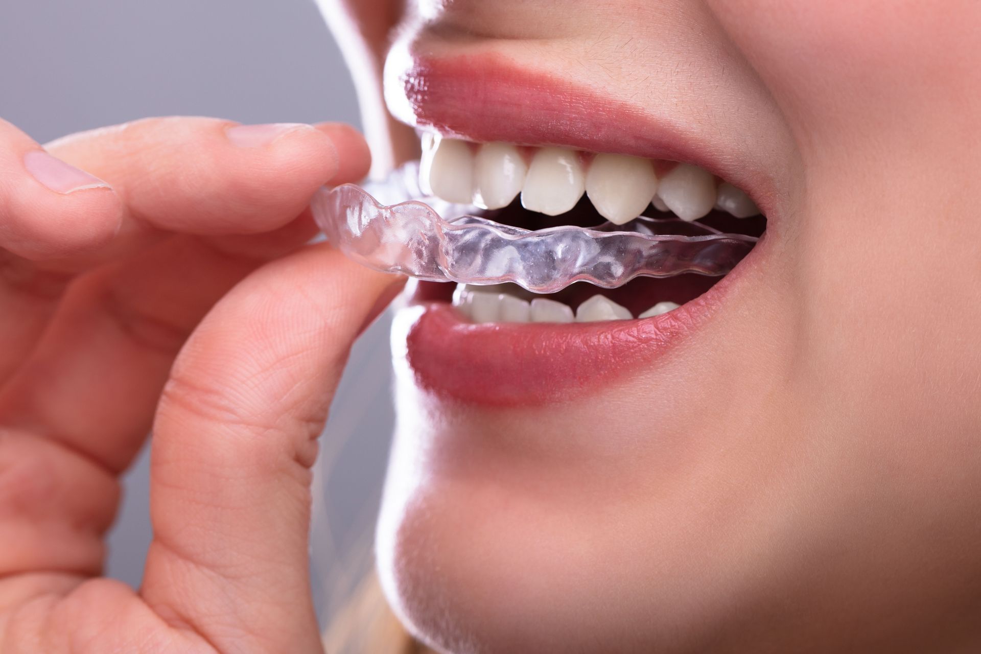 clear aligners