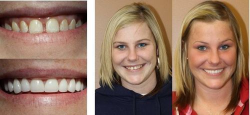Dental work comparison. Before and after photos of teeth and smiling woman.