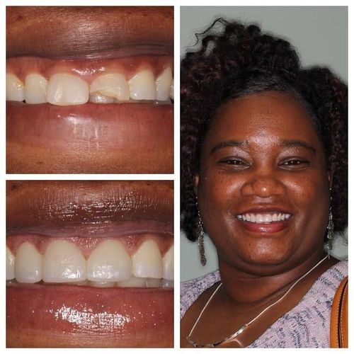 Dental composite repair before and after, showing tooth improvement. Happy woman smiles.