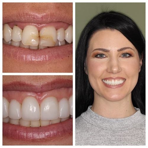 Before-and-after of dental work: Close-up of damaged teeth, then a healthy smile, and a smiling woman.