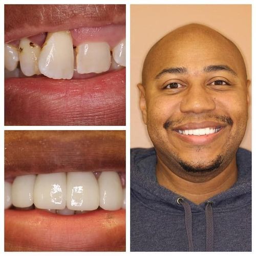 Before and after dental work: Man smiles showing improved teeth.