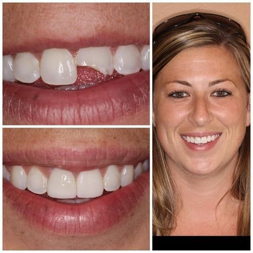 Before and after dental work: chipped tooth repaired. Woman smiles, showing white teeth, healthy gums.