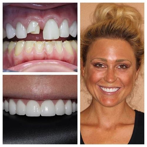 Before and after photos showing teeth with damage repaired, and a smiling woman.
