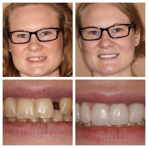 Before-and-after photos of a person with noticeable teeth issues, then a bright, new smile after dental work.