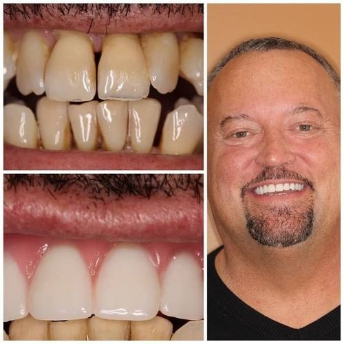 Teeth restoration before/after. Man smiling, close-up of teeth with discoloration, healthy gums and white teeth.