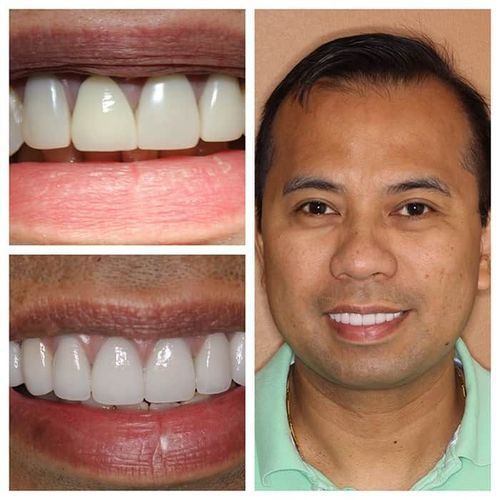 Man with bright, even teeth; close-ups of teeth before/after dental work.