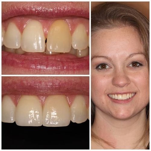 Before-and-after dental photos: yellow front tooth replaced with bright, white veneer; woman smiling.