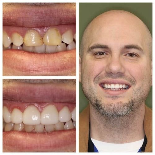 Man's teeth before and after dental work; the final photo shows a smiling man with bright, white teeth.