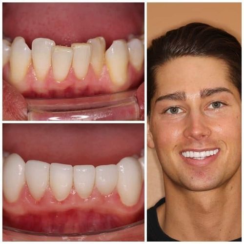 Teeth restoration comparison: Before with chipped tooth; after with bright, aligned teeth; man smiling.