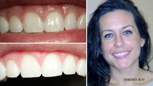 Woman with bright smile; close-up of teeth with pink gums, demonstrating healthy dental hygiene.