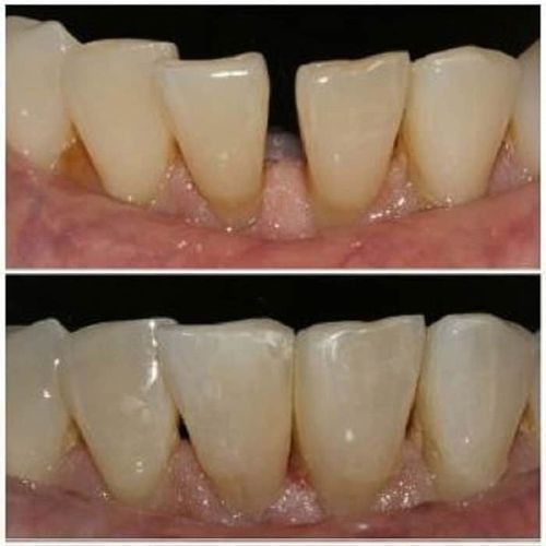 Upper and lower rows showing teeth with a gap, and the gap filled.