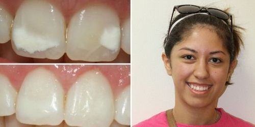 Teeth with white spots before and after treatment; smiling person wearing sunglasses.