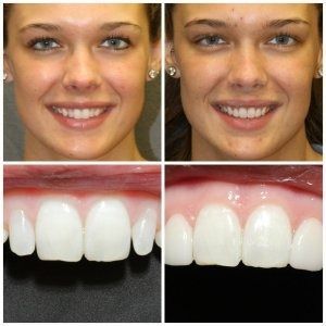 Before and after photos of a person's smile, showing the teeth's transformation from uneven to straight and white.